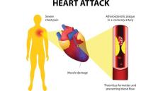 Những biến chứng nguy hiểm sau nhồi máu cơ tim