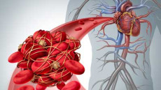 Những dấu hiệu cảnh báo nguy cơ huyết khối không thể bỏ qua