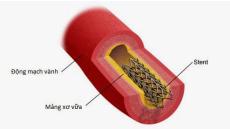 Điều trị sau đặt stent mạch vành hiệu quả phòng ngừa tái phát
