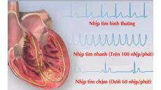 Rối loạn nhịp tim ở người già- đừng chủ quan