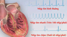 Rối loạn nhịp tim ở người già- đừng chủ quan