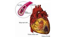 Suy tim độ 4 - Trạm dừng chân cuối cùng của hầu hết các bệnh tim mạch