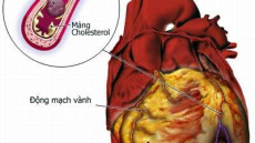 Suy tim độ 4 - Trạm dừng chân cuối cùng của hầu hết các bệnh tim mạch