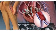 Cập nhật điều trị bệnh động mạch chi dưới hiệu quả