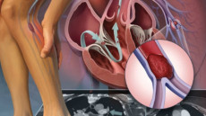 Cập nhật điều trị bệnh động mạch chi dưới hiệu quả