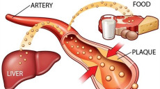 Rối loạn lipid máu và nguy cơ bệnh tim mạch 