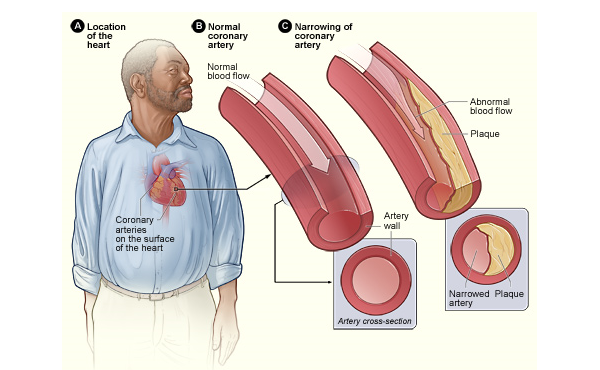 Nhận biết và phòng ngừa bệnh mạch vành