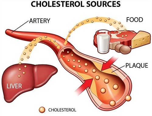 Bệnh rối loạn mỡ máu (lipid máu, tăng cholesterol trong máu)