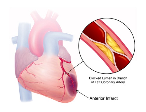 Hãy thận trọng khi dùng thuốc cảm để bảo vệ tim mạch
