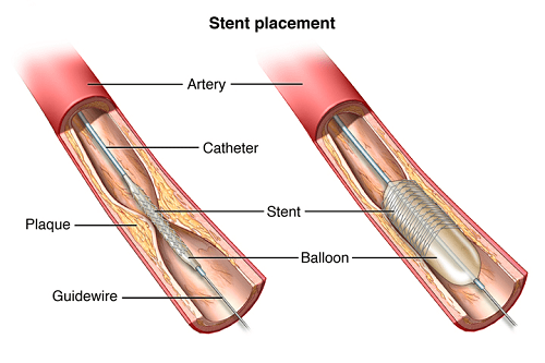 Stent động mạch vành là gì?