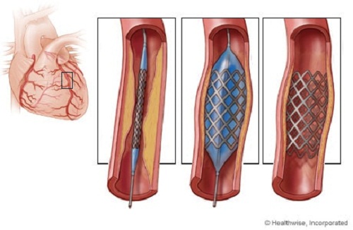 Đặt stent động mạch vành cần đi kiểm tra lại không?