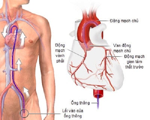 Chụp động mạch có thể hỗ trợ chẩn đoán suy tim