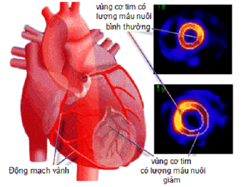Thiếu máu cơ tim có thể dẫn đến hở van hai lá