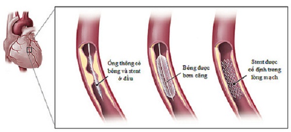 Bệnh nhân sau khi đặt stent mạch vành có dùng được cây dong riềng đỏ không?
