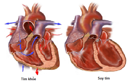 Dấu hiệu bệnh suy tim phải bạn bên biết