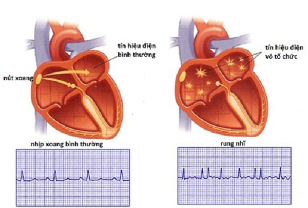 Một số dấu hiệu rối loạn nhịp tim thường gặp
