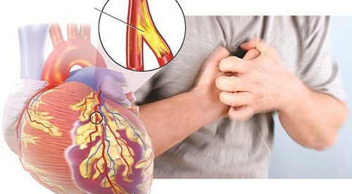 Bệnh mạch vành gây đau thắt ngực