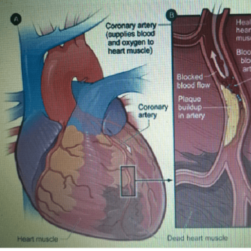 Chụp và can thiệp động mạch vành qua da (hình minh họa)