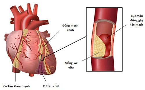 Xơ vữa động mạch vành là nguyên nhân gây ra bệnh tim mạch