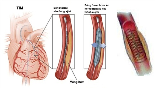 Cách hỗ trợ chữa hẹp tắc động mạch vành: Nên uống thuốc, đặt stent hay phẫu thuật?