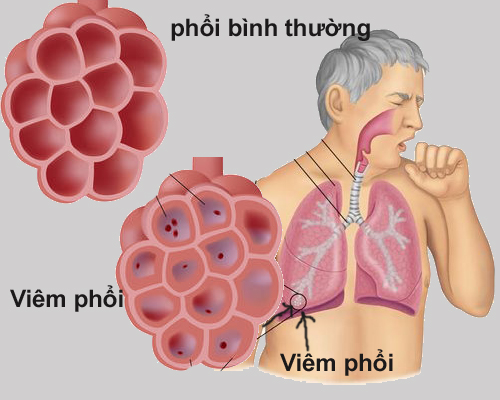 Khó thở ở người cao tuổi do bệnh phổi