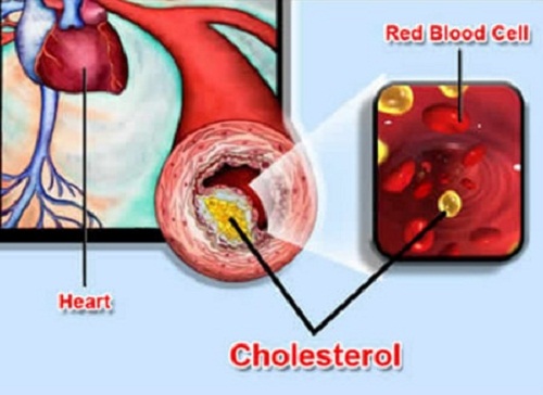 Rối loạn mỡ máu, yếu tố nguy cơ bệnh mạch vành, huyết áp cao