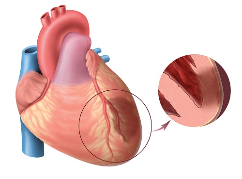 Sơ cứu nhồi máu cơ tim như nào cho đúng?