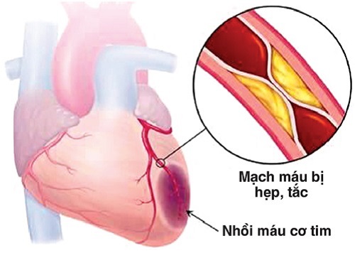 Tổng quan về bệnh thiếu máu cơ tim thầm lặng nguy hiểm