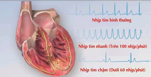 Thiếu máu cơ tim, suy tim có thể gây tim đập nhanh khó thở