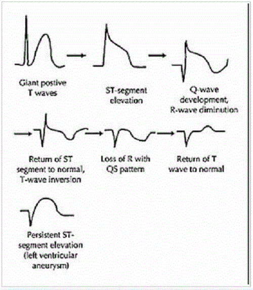 Các giai đoạn nhồi máu cơ tim trên điện tâm đồ