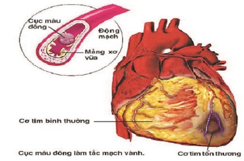 Tầm quan trọng của điện tâm đồ nhồi máu cơ tim và hình ảnh của chúng