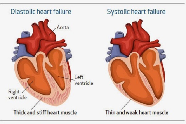 Các tiêu chuẩn chẩn đoán trong bệnh suy tim