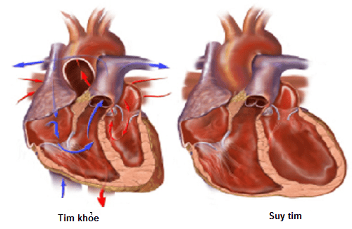 Suy tim được phân độ theo nhiều mức khác nhau