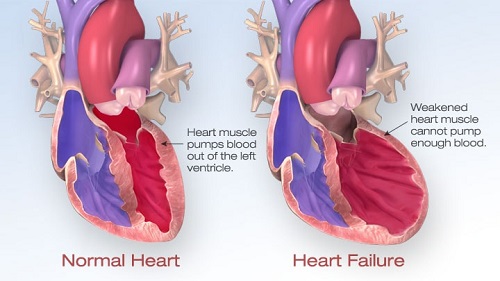 Huyết áp cao biến chứng thành bệnh suy tim nguy hiểm