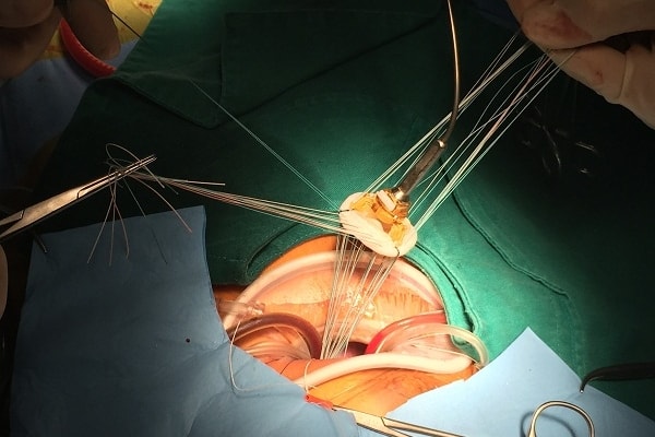 Hình ảnh ca phẫu thuật thay van tim nhân tạo